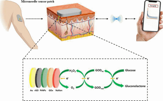 An Electrochemical Microneedle Biosensor with Wide Linear Range for Continuous Glucose Monitoring